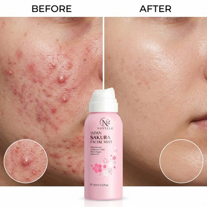 Novelle Anti-Acne Spray